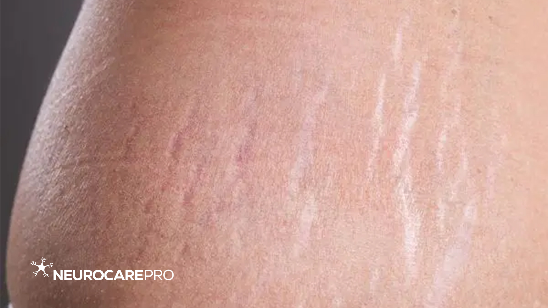 Treat Stretch Marks with Red Light Therapy