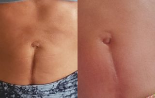 Before and After picture of red light therapy on tummy