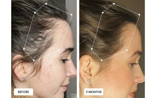 before and after hair regrowth using red light therapy