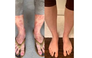 eczema treatment with red light therapy