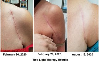 wound healing before and after with red light therapy