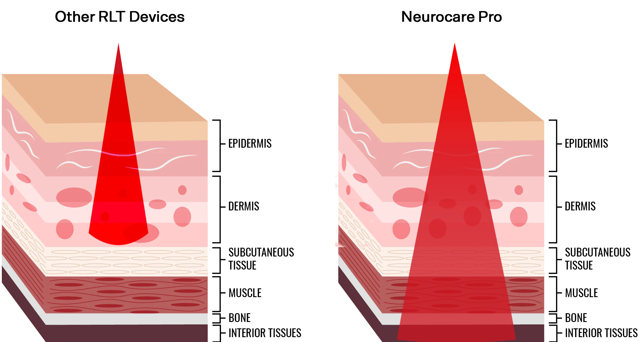 us_vs_them_vs3_lbd Difference in absorption and permeation on NeurocarePro polychromatic pulsed light systems vs monocrhomatic systems